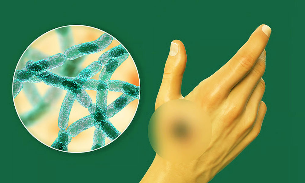 সুন্দরগঞ্জে নারীর মৃত্যু অ্যানথ্রাক্সের কারণে নয় : স্বাস্থ্য বিভাগ