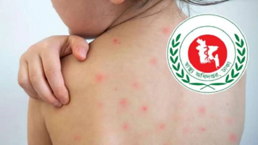 ২৪ ঘণ্টায় হাম সন্দেহে আরও ৪ শিশুর মৃত্যু