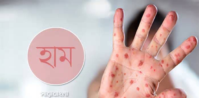 হাম ও হামের উপসর্গে আটদিনে ৩৬ শিশুর মৃত্যু